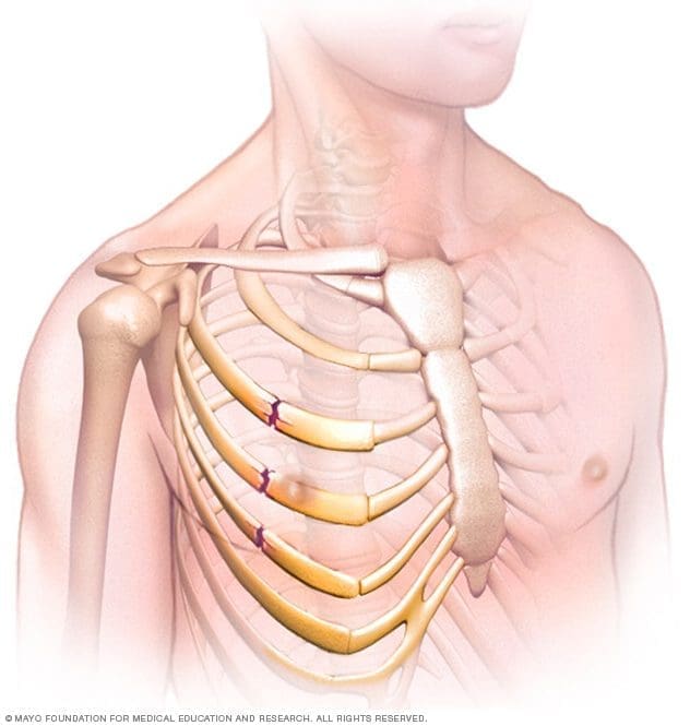 How to Recognize, Treat & Monitor Chest Injuries